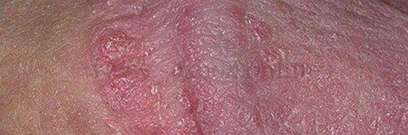 Piel seca y úlceras en la cabeza del pene después de usar polvo de hornear