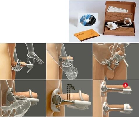 Alargamiento del pene con extensor