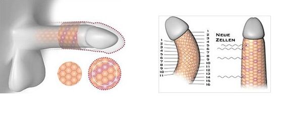Resultado de la cirugía de agrandamiento del pene.