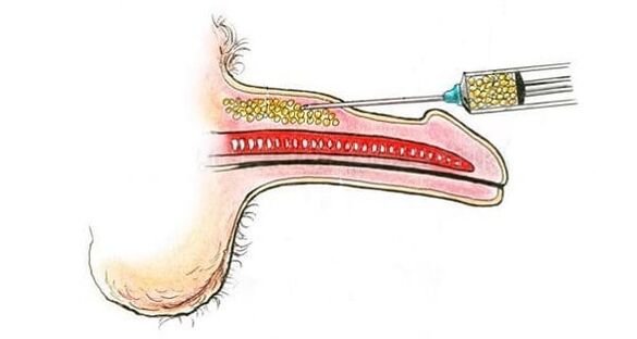 Trasplante de tejido muscular para agrandar el pene