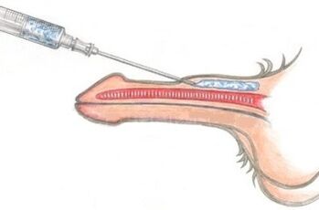 Un método peligroso para agrandar el pene mediante inyecciones de vaselina.